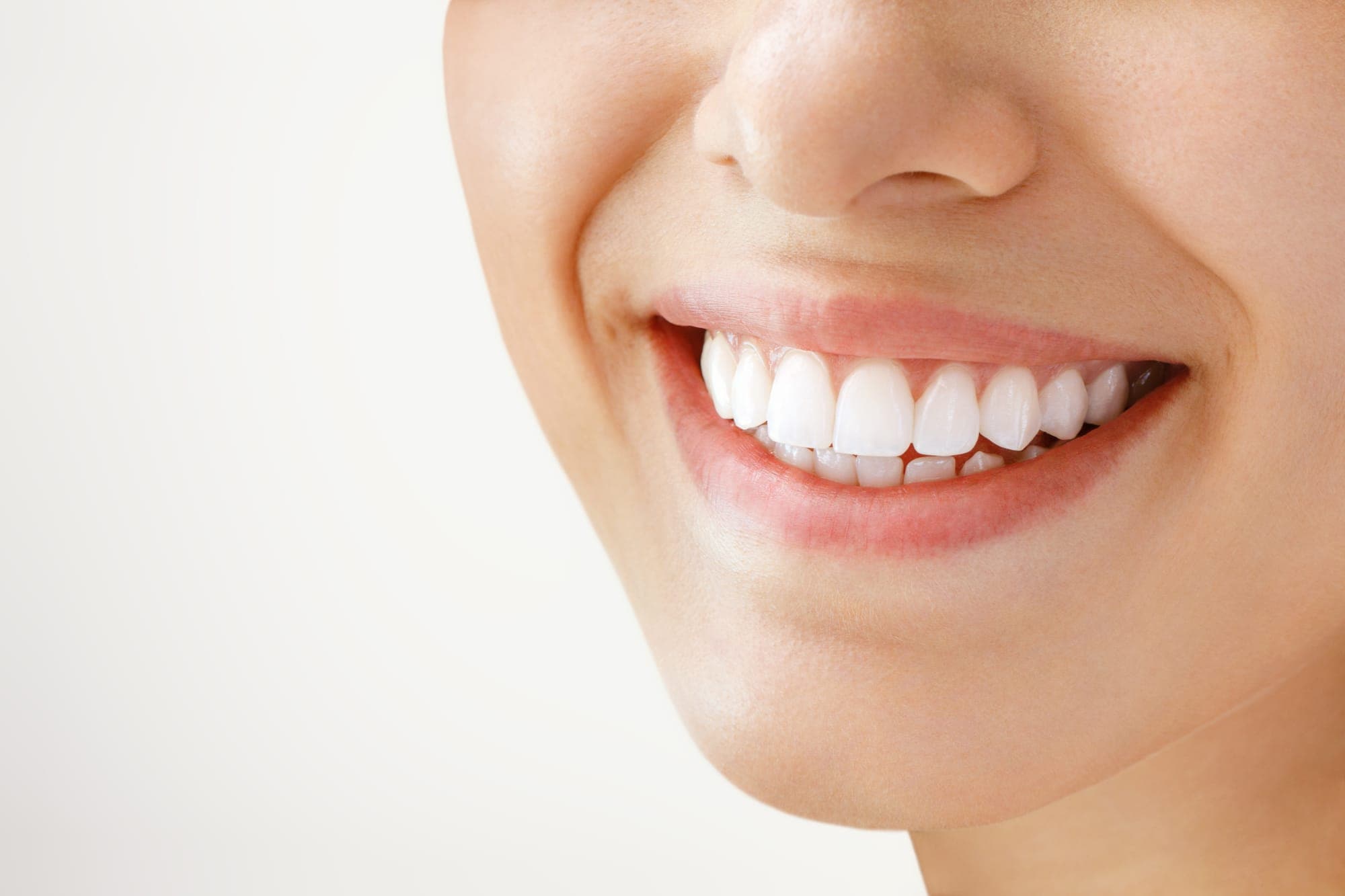 Professional teeth whitening results at Royal Oak Smiles NW Calgary